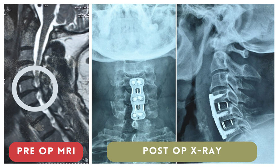 Cervical Myelopathy surgery