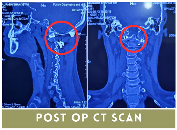 Cervical Myelopathy surgery