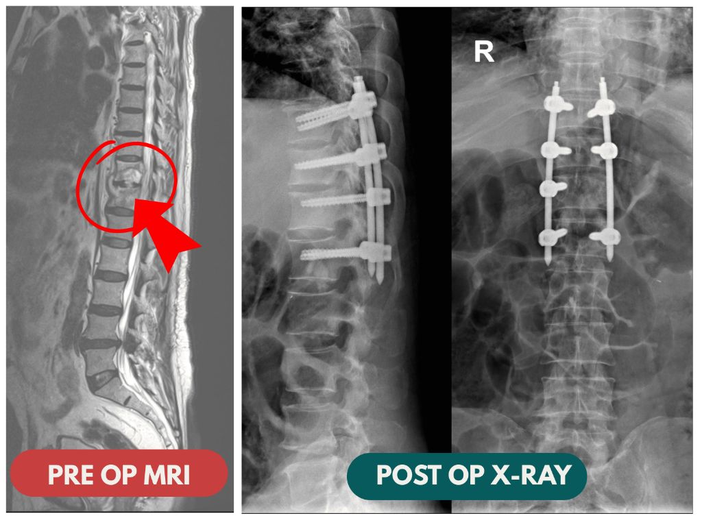 Dr Hitesh Garg treats Spinal TB in an international patient