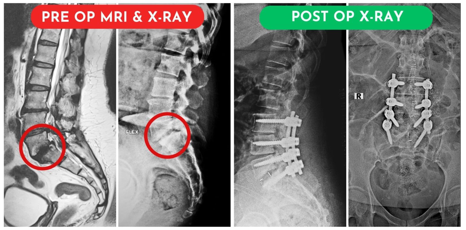 transforaminal interbody fusion surgery