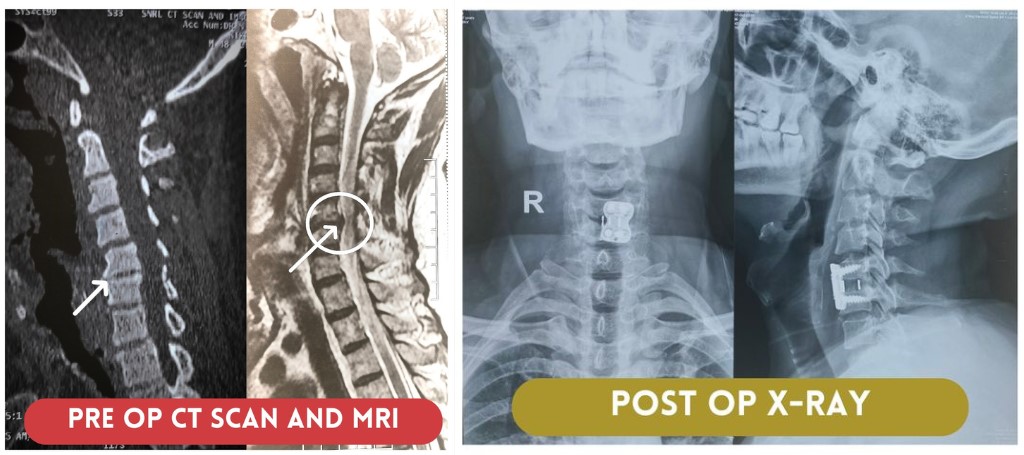 L4-L5 recurrent radiculopathy