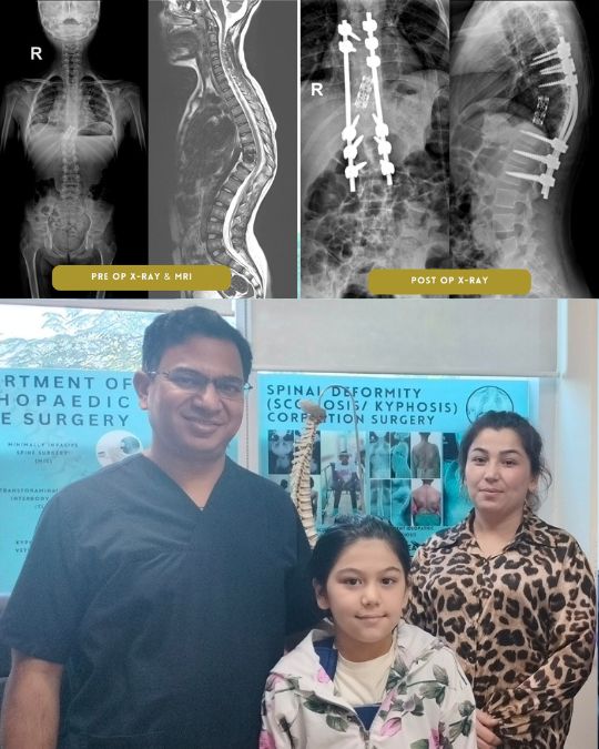 Kyphosis Surgery