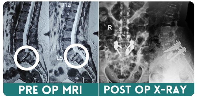 transforaminal interbody fusion surgery