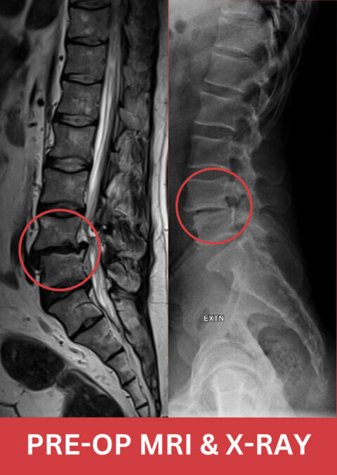 Successful OLIF Surgery in India | Case Study for a 35-year-old ...