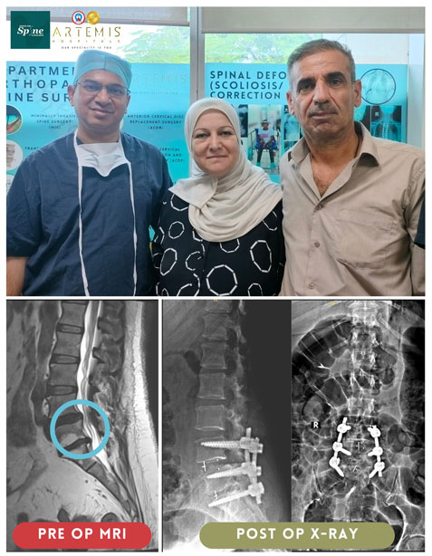 Mrs. Rzgara Ibrahim, a resident of Kurdistan, Iraq - tlif surgery in India