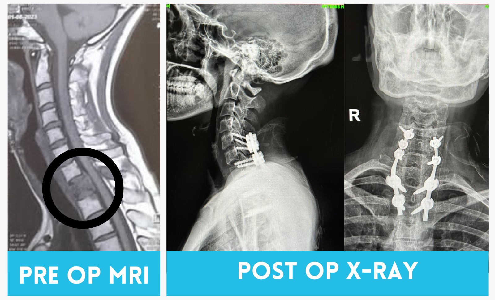 From Spinal Fracture to Recovery for a 29-year-old young female