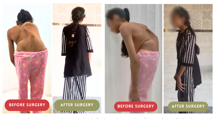 Success Story: A Kurdish Girl’s Triumph Over Scoliosis