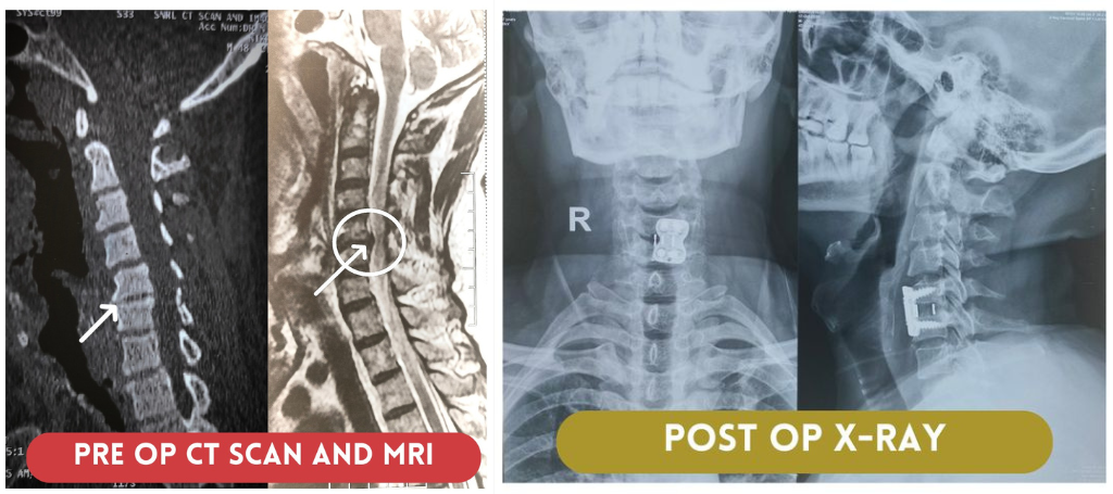 A Medical Emergency: Successful Spine Surgery of 47 year old Man